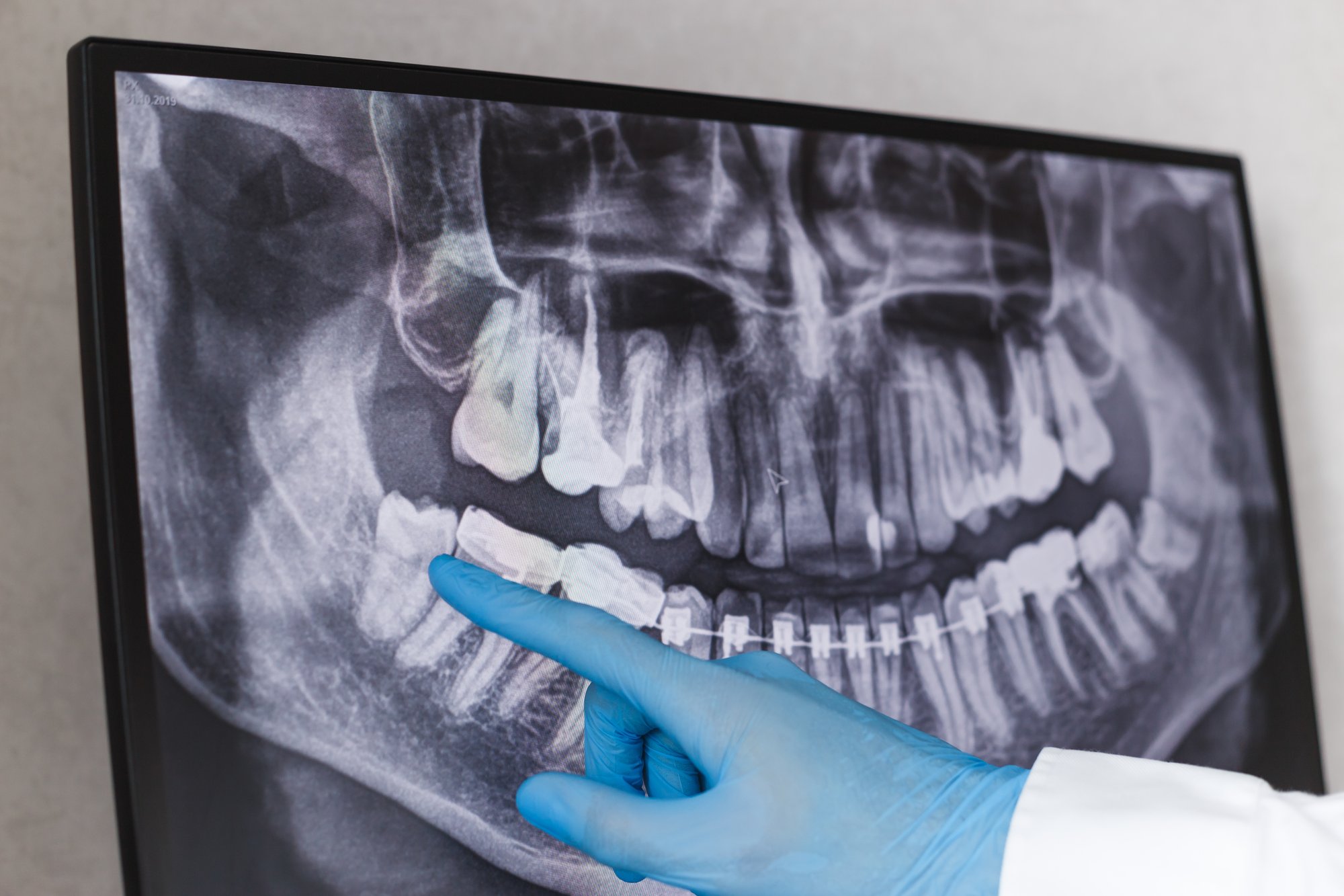 Soft foods like yogurt and soup prepared for recovery after oral surgery